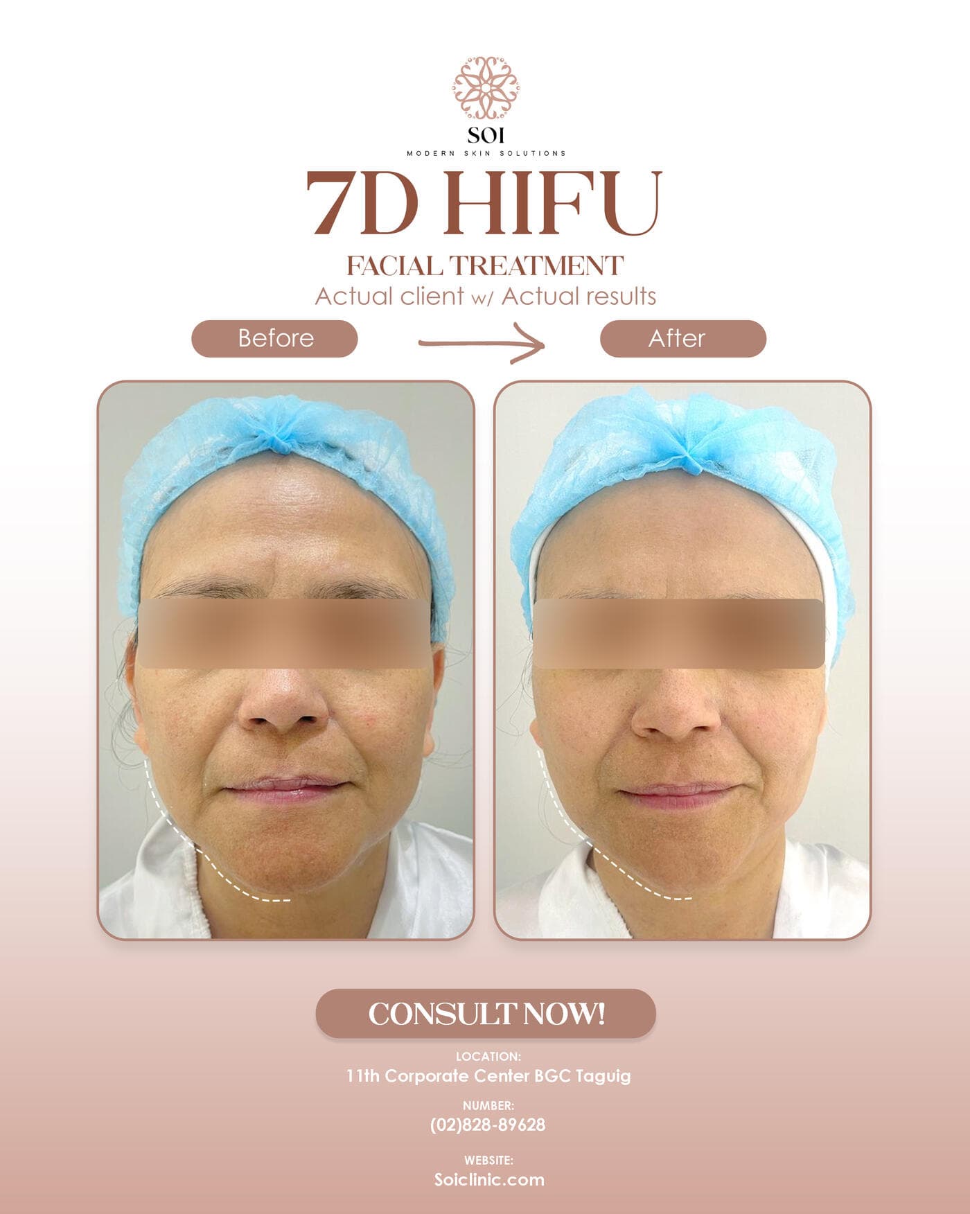 7D HIFU II before and after results at SOI Clinic, Manila