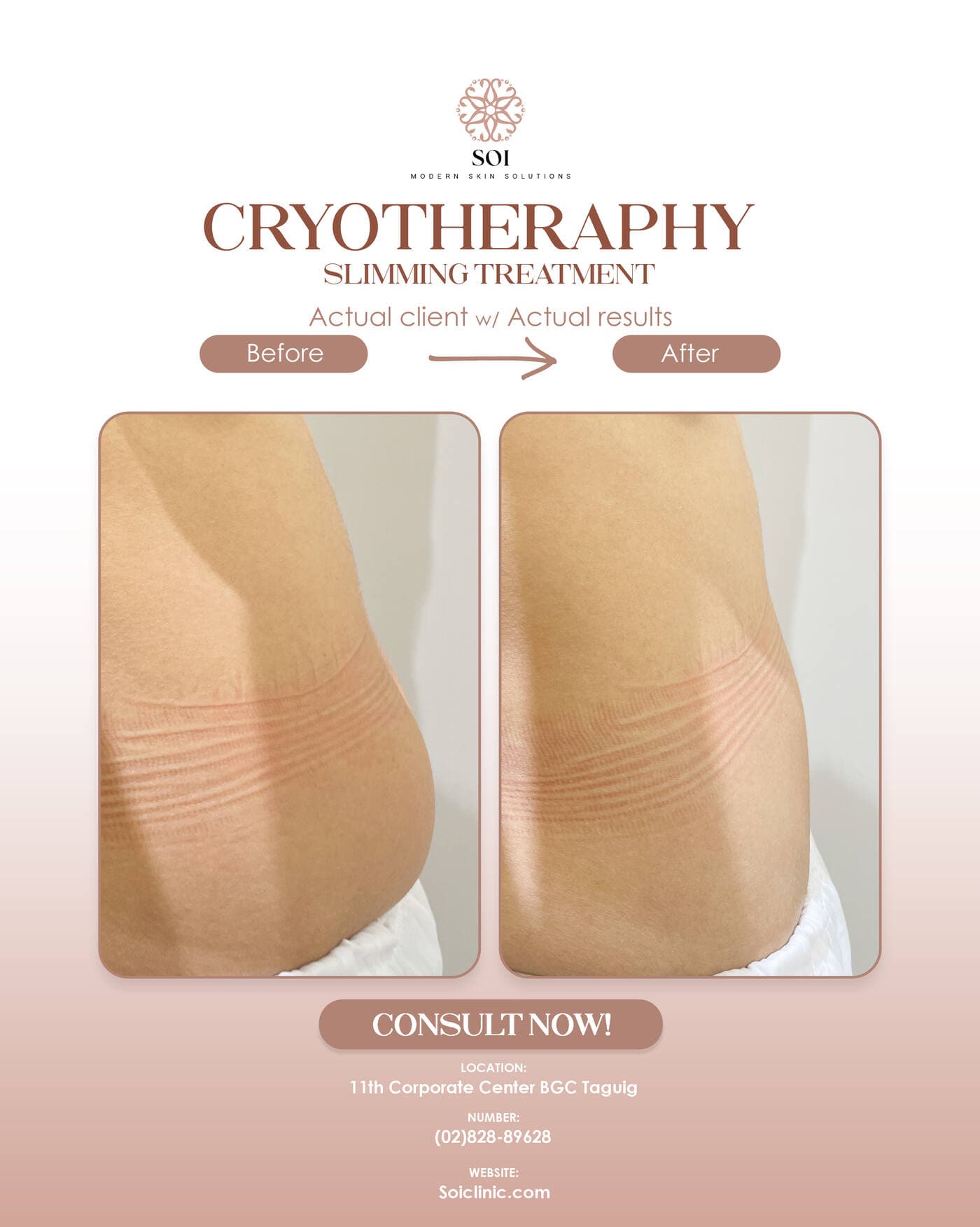 Cryotherapy before and after results at SOI Clinic, Manila