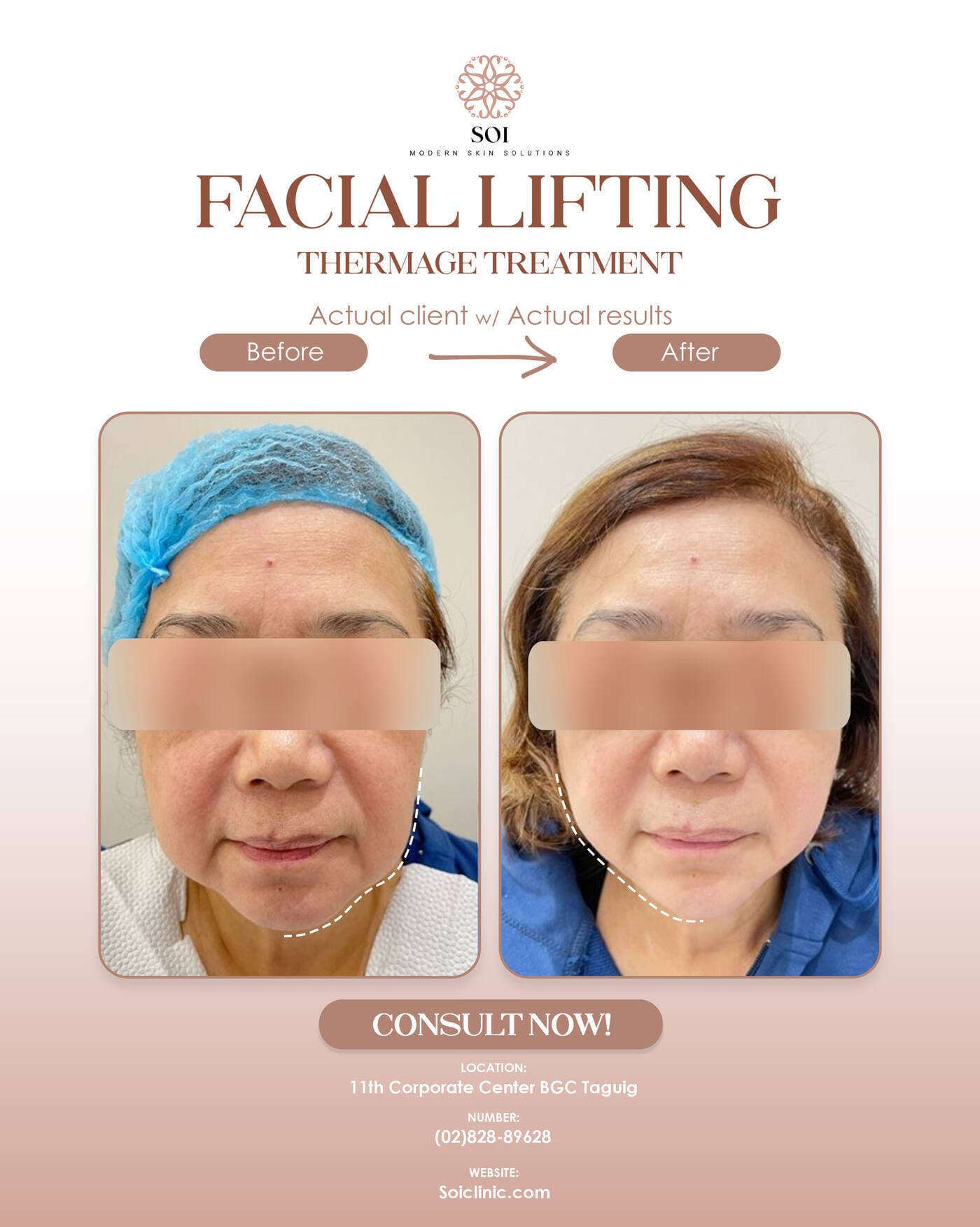 Facial Lifting before and after results at SOI Clinic, Manila