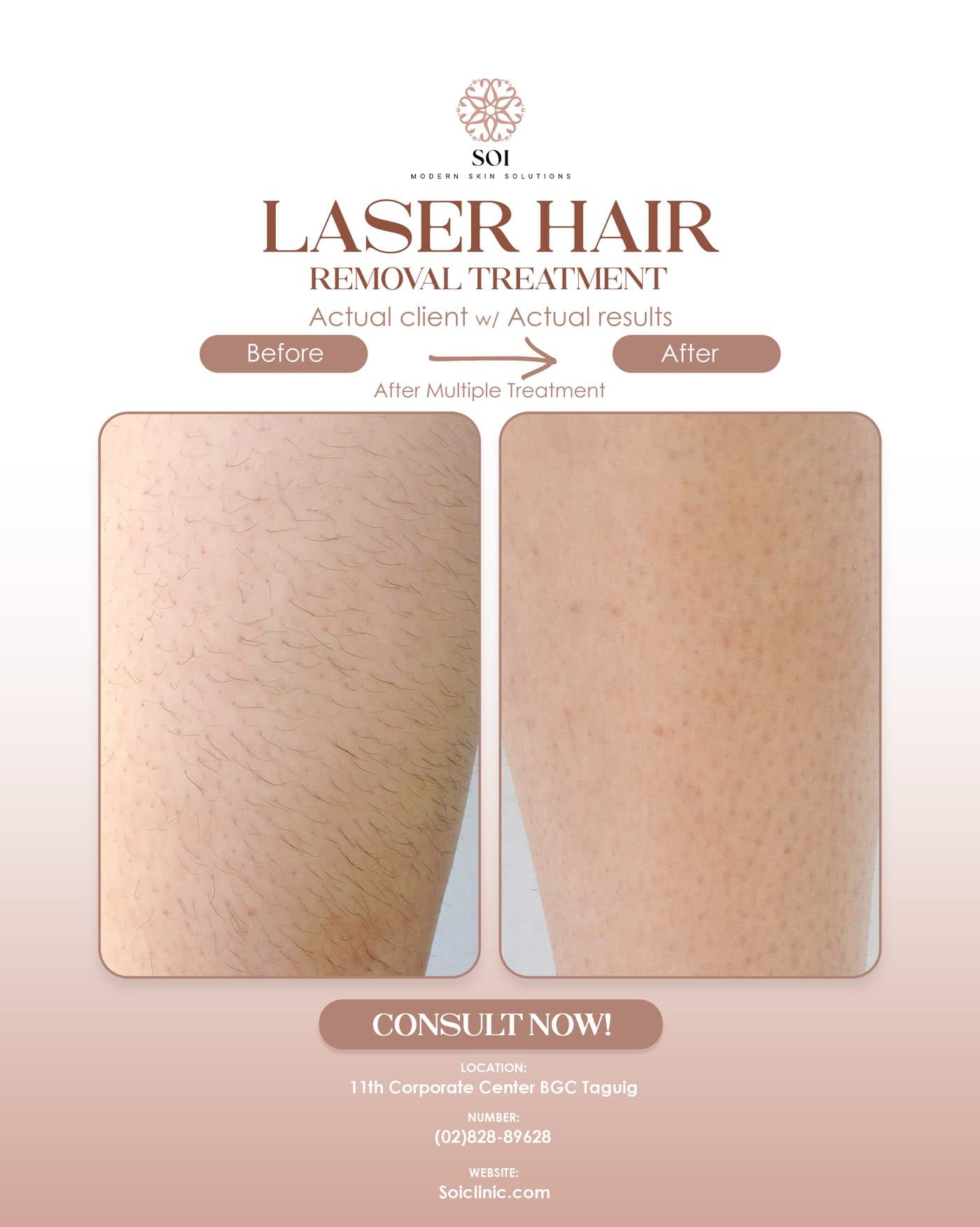 Laser Hair III before and after results at SOI Clinic, Manila