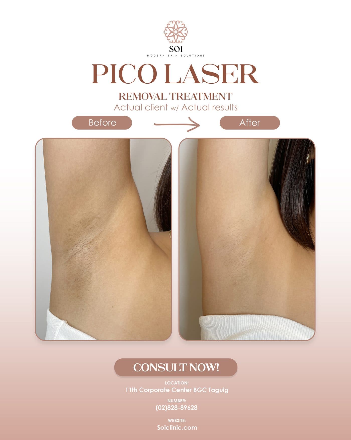 Pico Laser before and after results at SOI Clinic, Manila