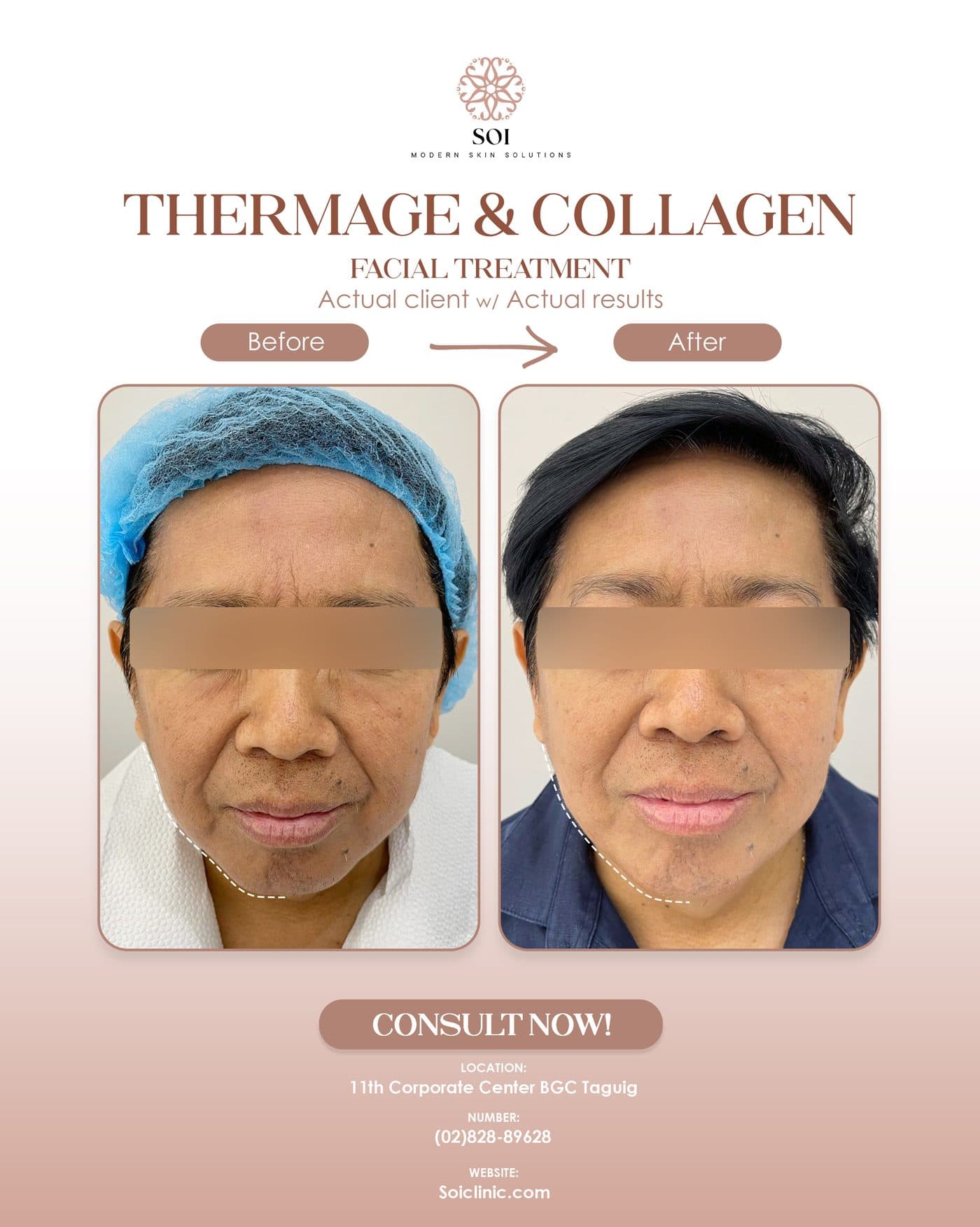 Tightening & Collagen before and after results at SOI Clinic, Manila