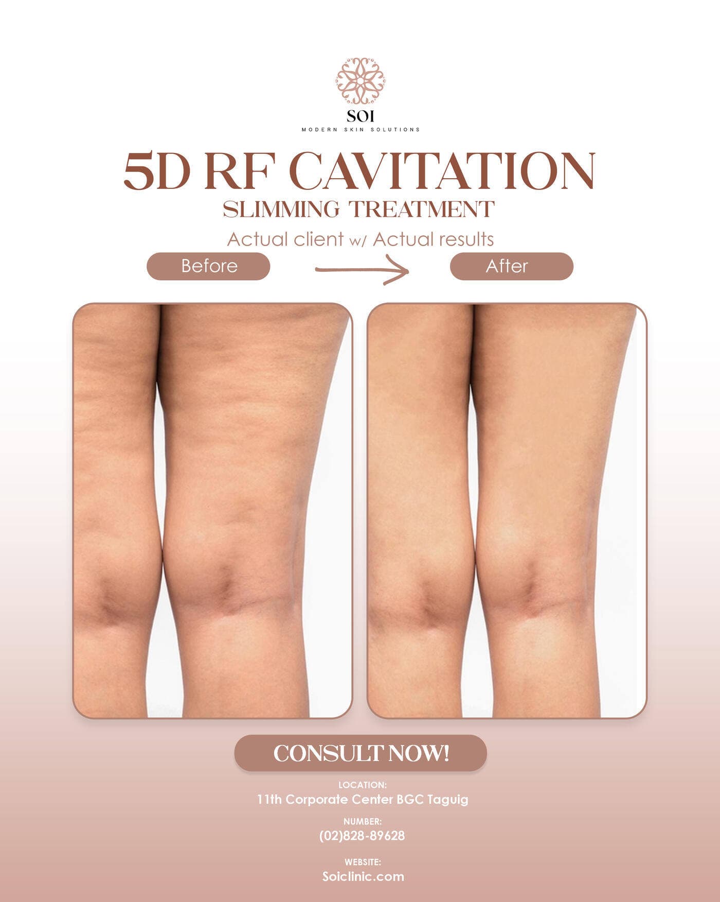 5D Cavitation before and after results at SOI Clinic, Manila