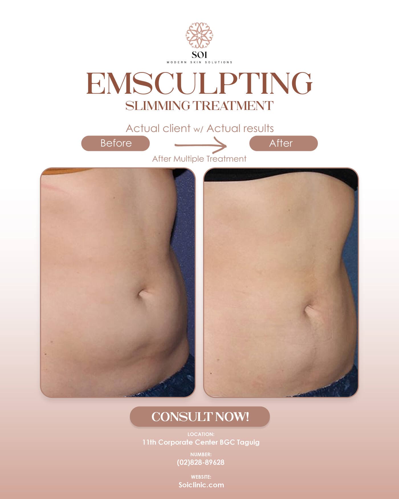 Ab-Toning before and after results at SOI Clinic, Manila
