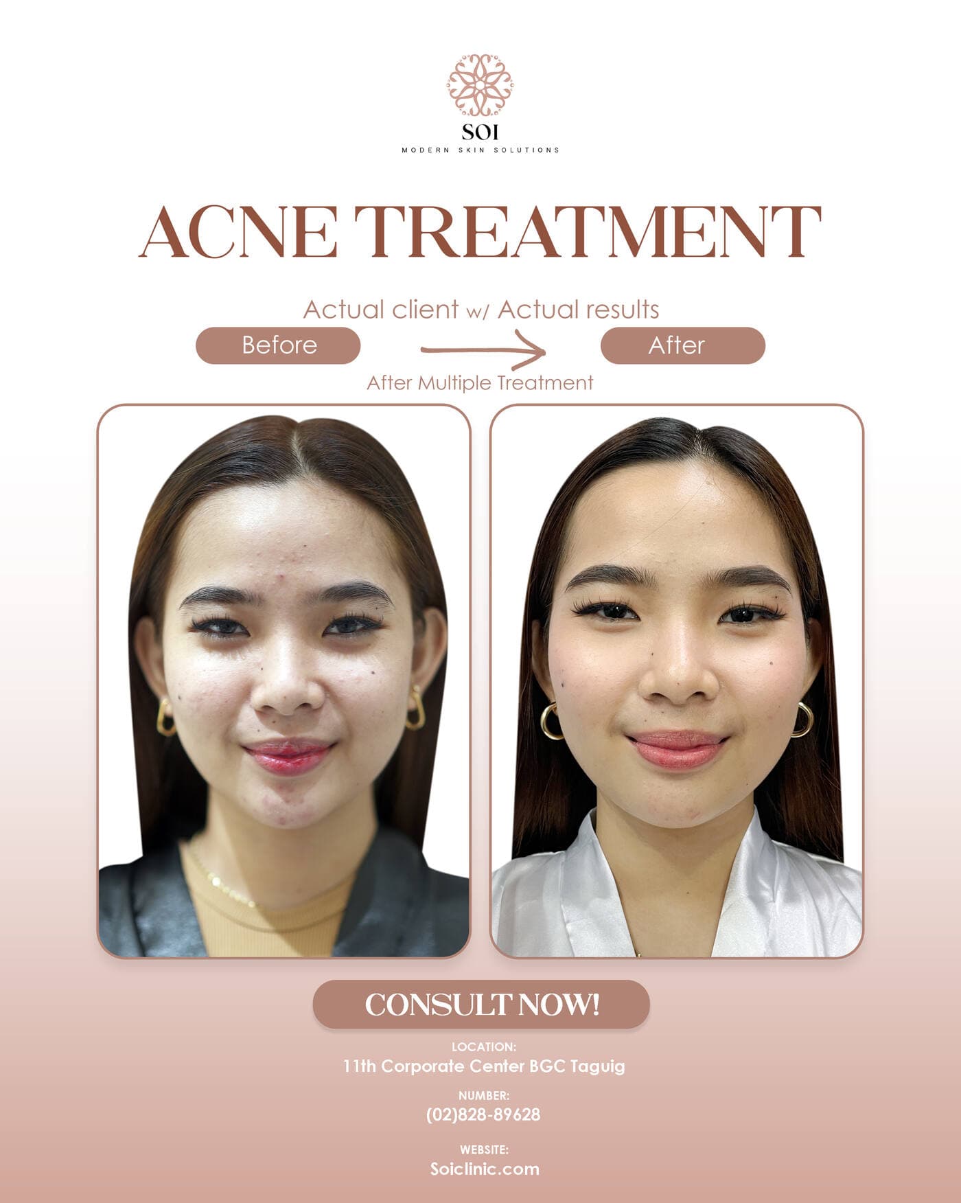 Acne Treatment before and after results at SOI Clinic, Manila