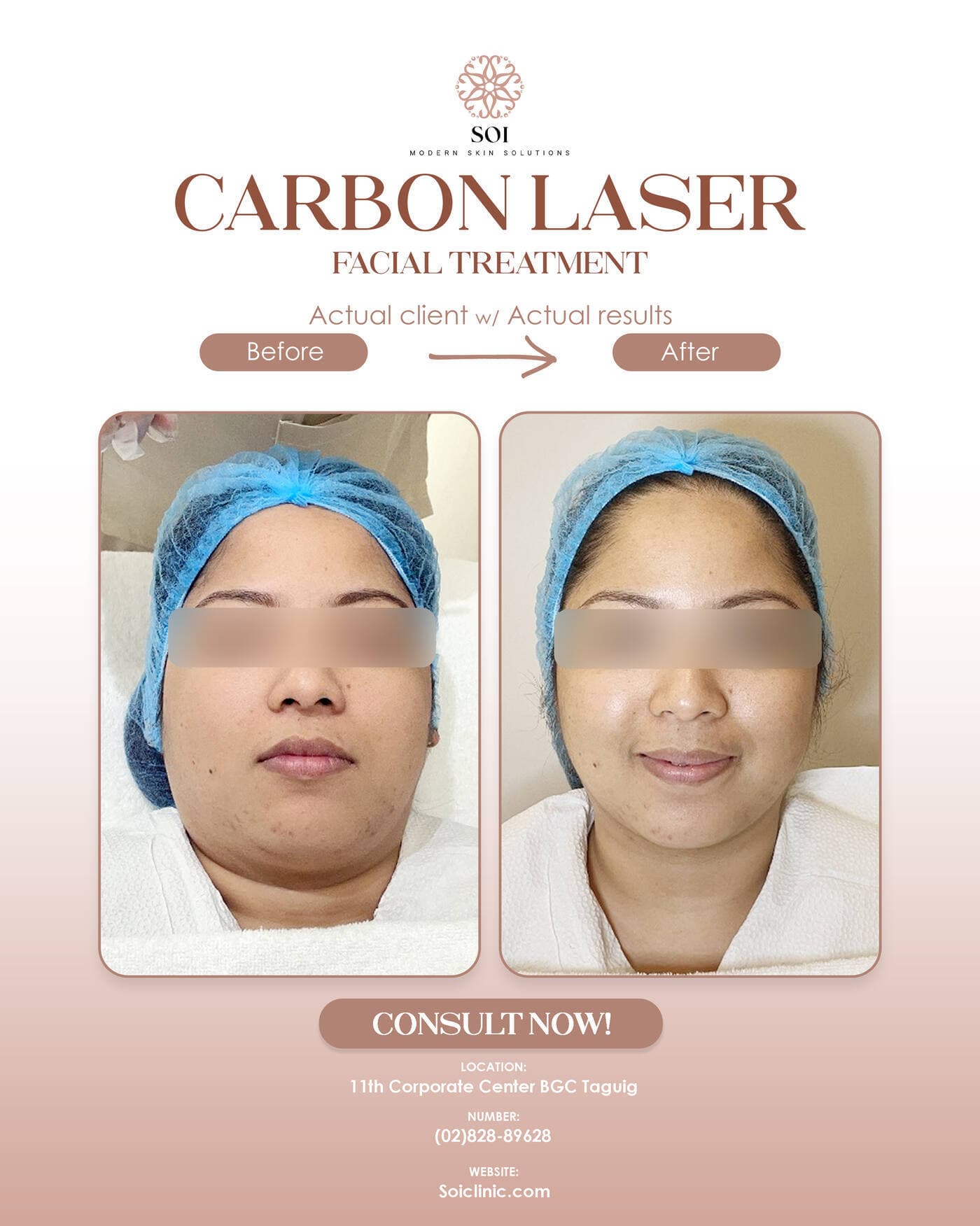 Carbon Laser before and after results at SOI Clinic, Manila