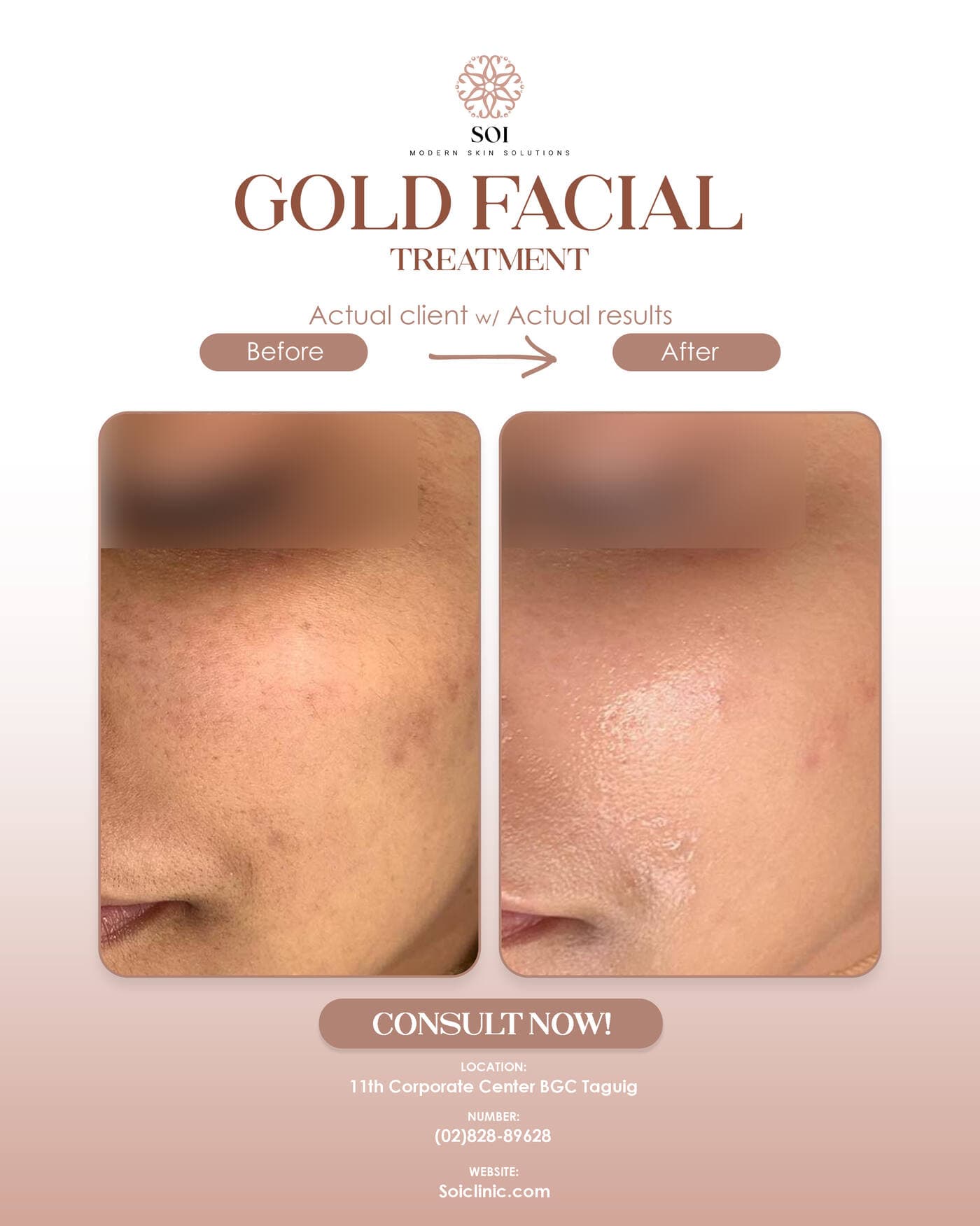 Gold Facial before and after results at SOI Clinic, Manila