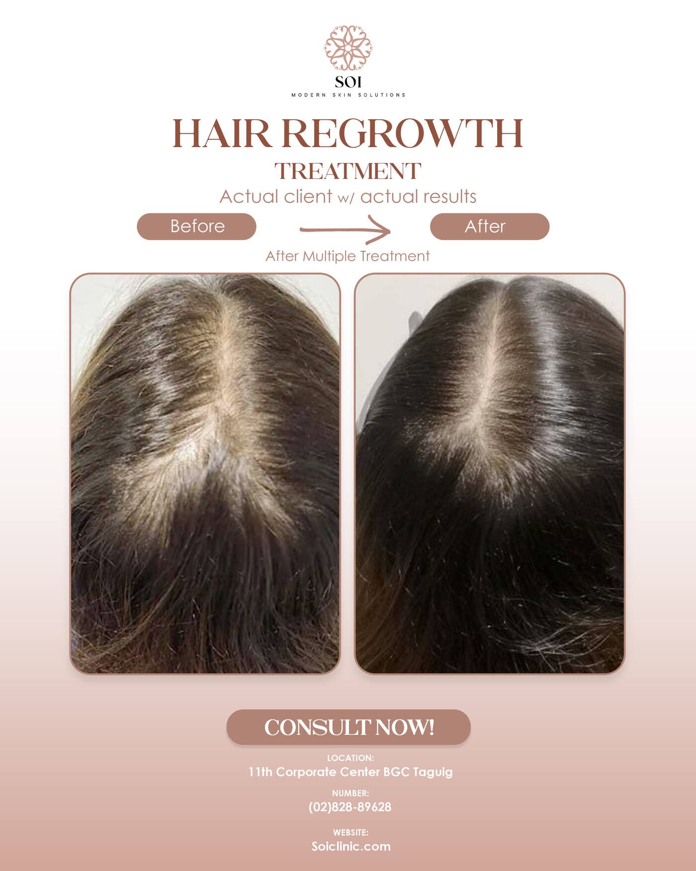 Hair Regrowth before and after results at SOI Clinic, Manila