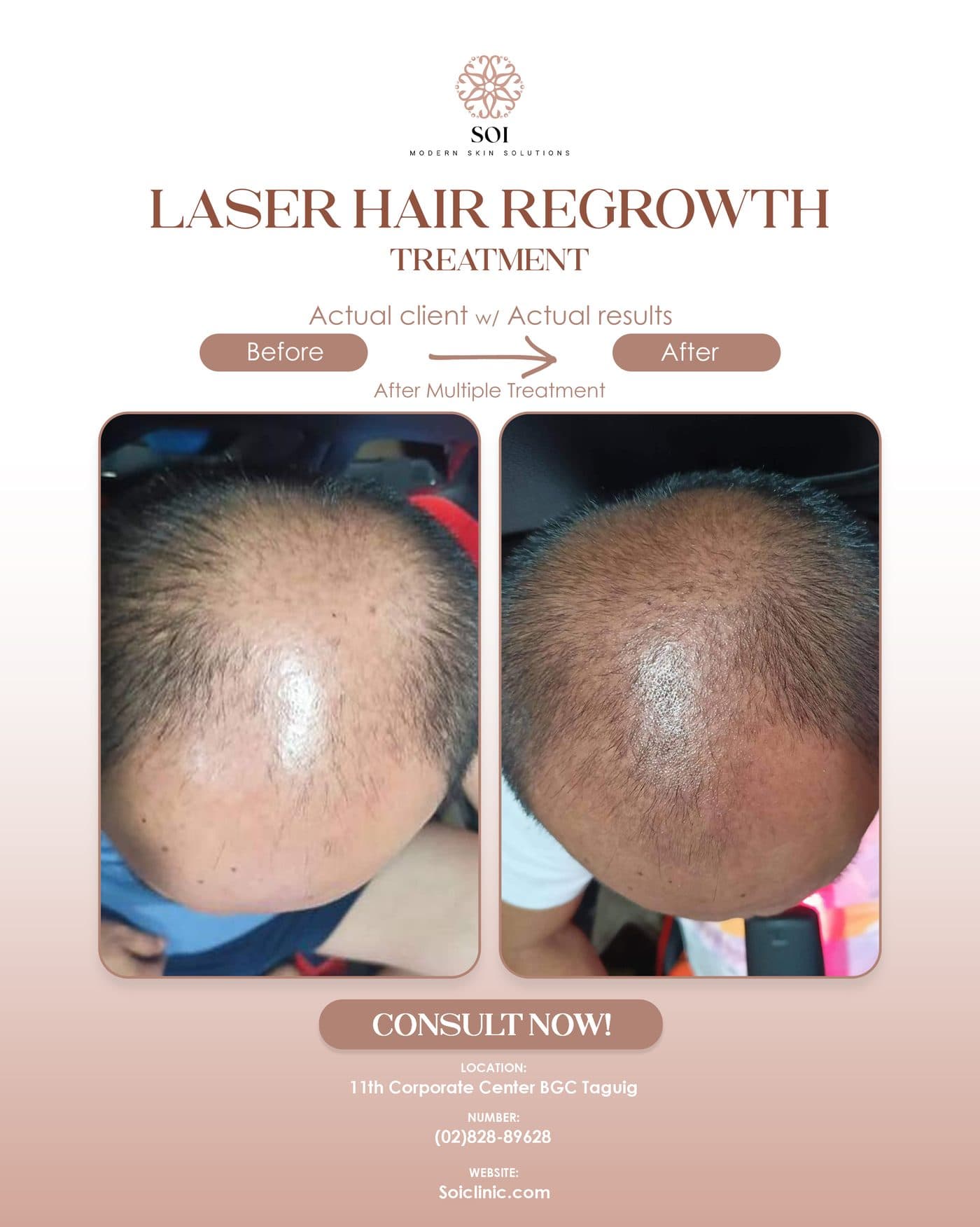 Laser Hair Regrowth before and after results at SOI Clinic, Manila