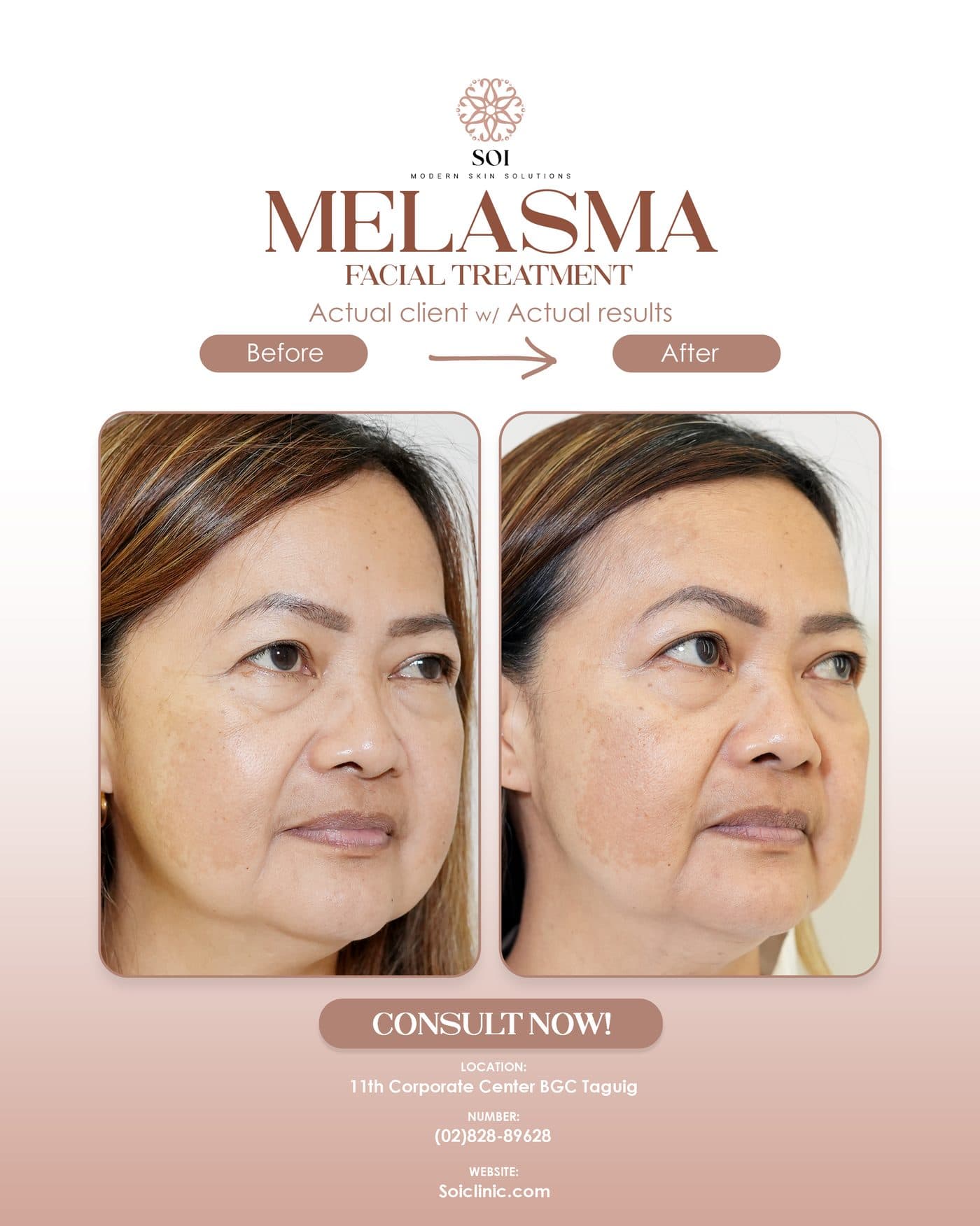 Melasma before and after results at SOI Clinic, Manila