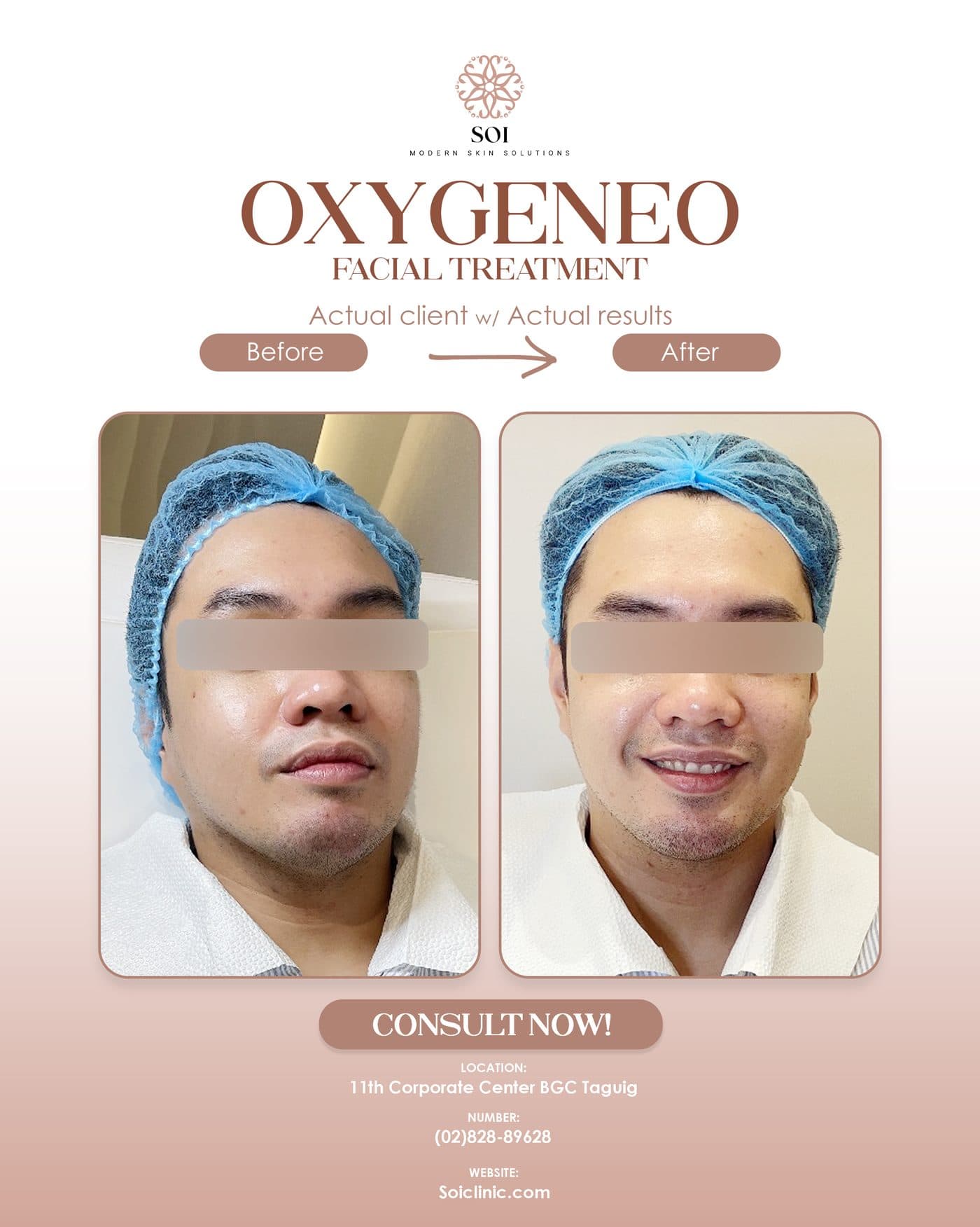 Oxygen Facial before and after results at SOI Clinic, Manila