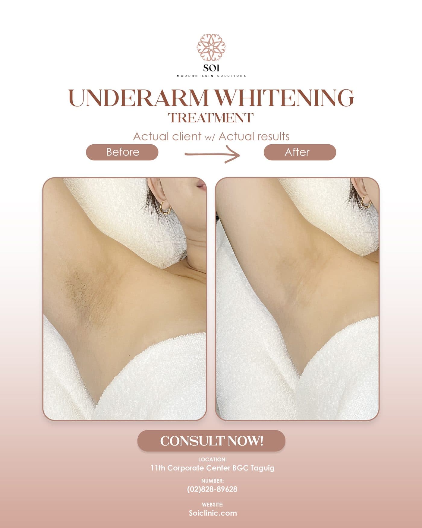 Under Arm Whitening before and after results at SOI Clinic, Manila
