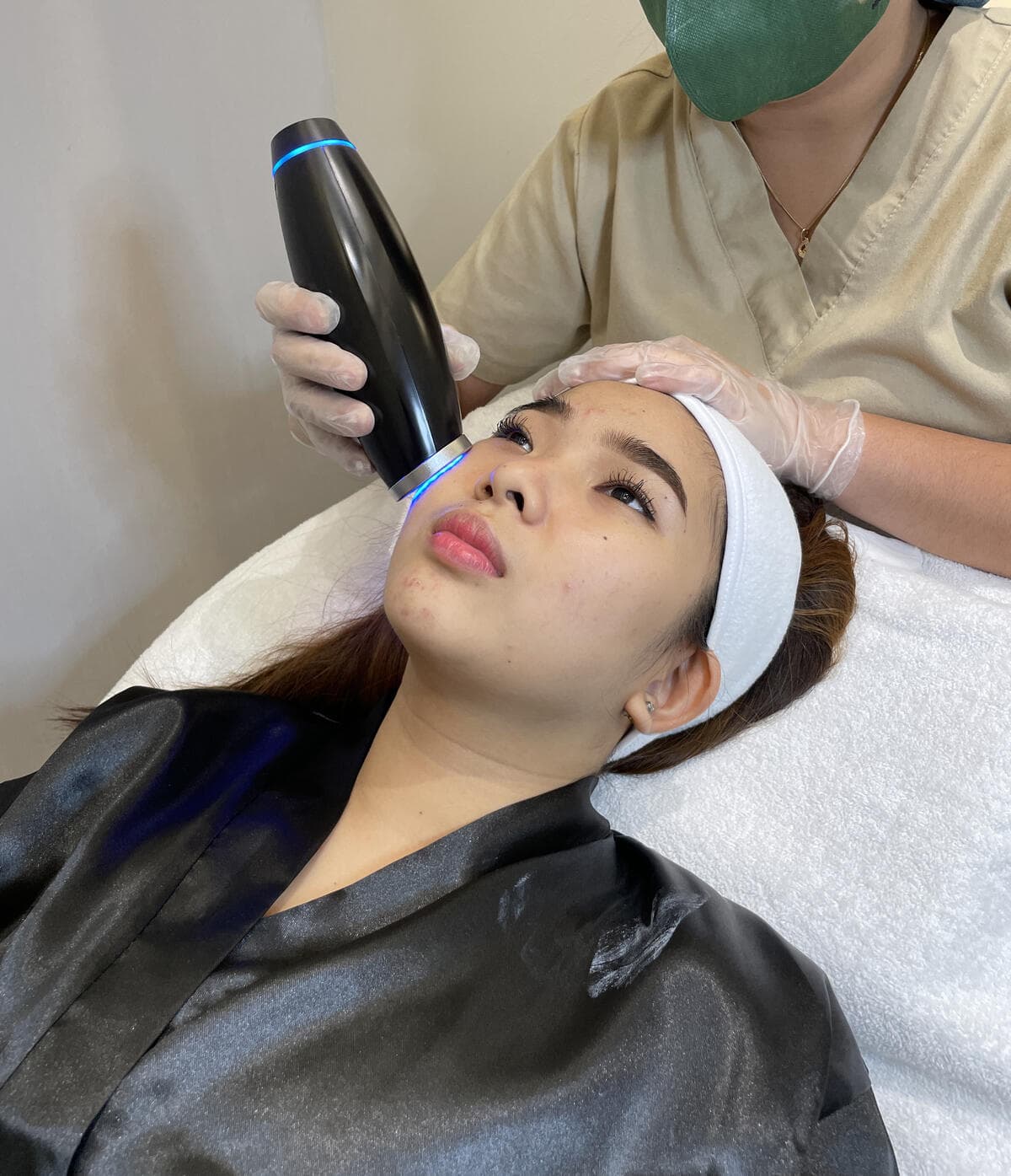 RF microneedling and brightening treatment for melasma at SOI Clinic