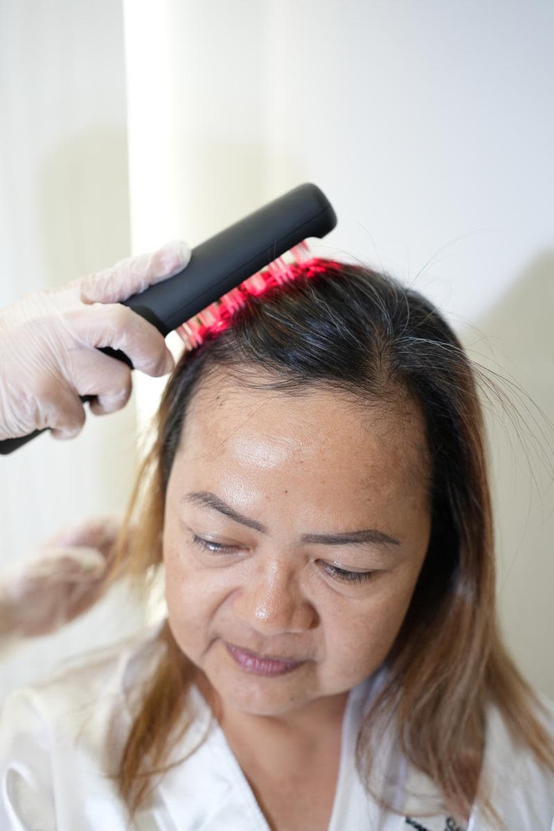 Lusher, Fuller Locks treatment at SOI Clinic